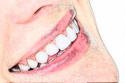 什么是牙齿正畸矫正