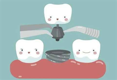 老年人种牙好还是镶牙好？镶牙的方式有哪些？